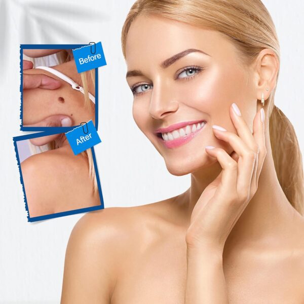 Skin Tag Remover 06